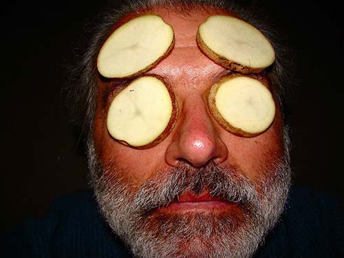 potato slices for headaches