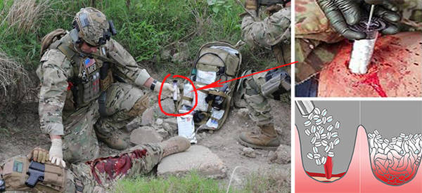 Emergency Care For Gunshot Wounds