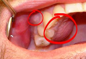 Tooth-Abscess-3