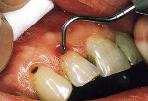 Caries removal using Carisolv