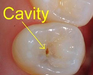 cavity