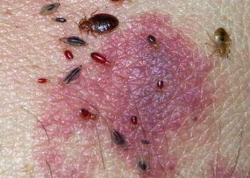 5 Most Likely Infections You’ll Catch When The SHTF