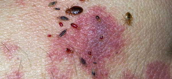 5 Most Likely Infections You’ll Catch When The SHTF