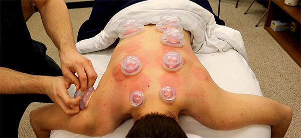 How To Use The Old Cupping Method To Get Rid Of Back Pain
