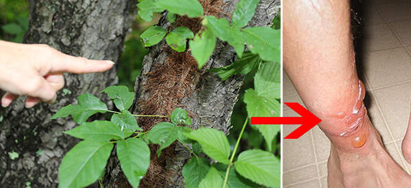 The Best Natural Treatments for Poison Ivy and Poison Oak