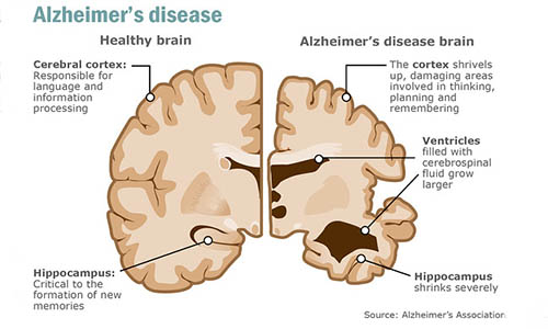 Study: THC Removes Toxic Protein that Causes Alzheimer’s from the Brain