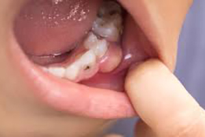 SHTF dental care