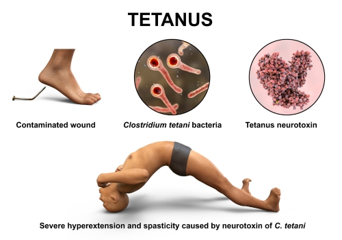 Tetanus scheme