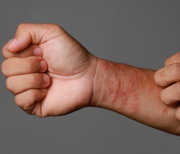 skin allergy