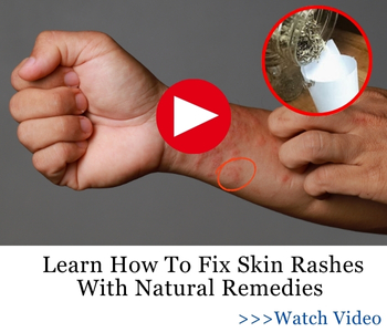 Learn How To Fix Skin Rashes With Natural Remedies BOR2