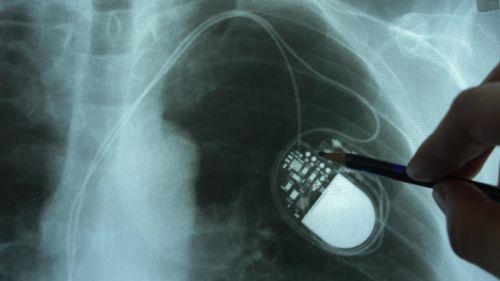 pacemaker