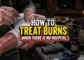 how to treat burns when there is no hospital